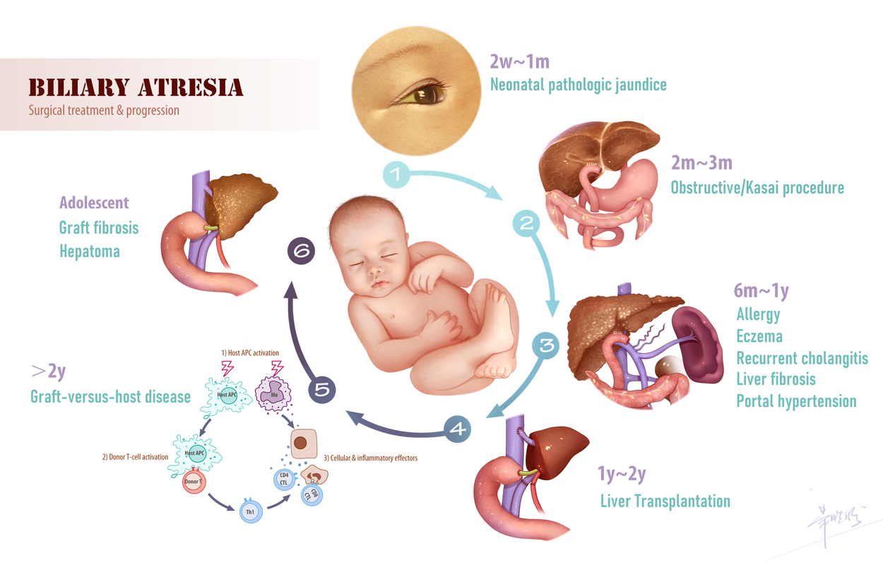 Biliary Atresia