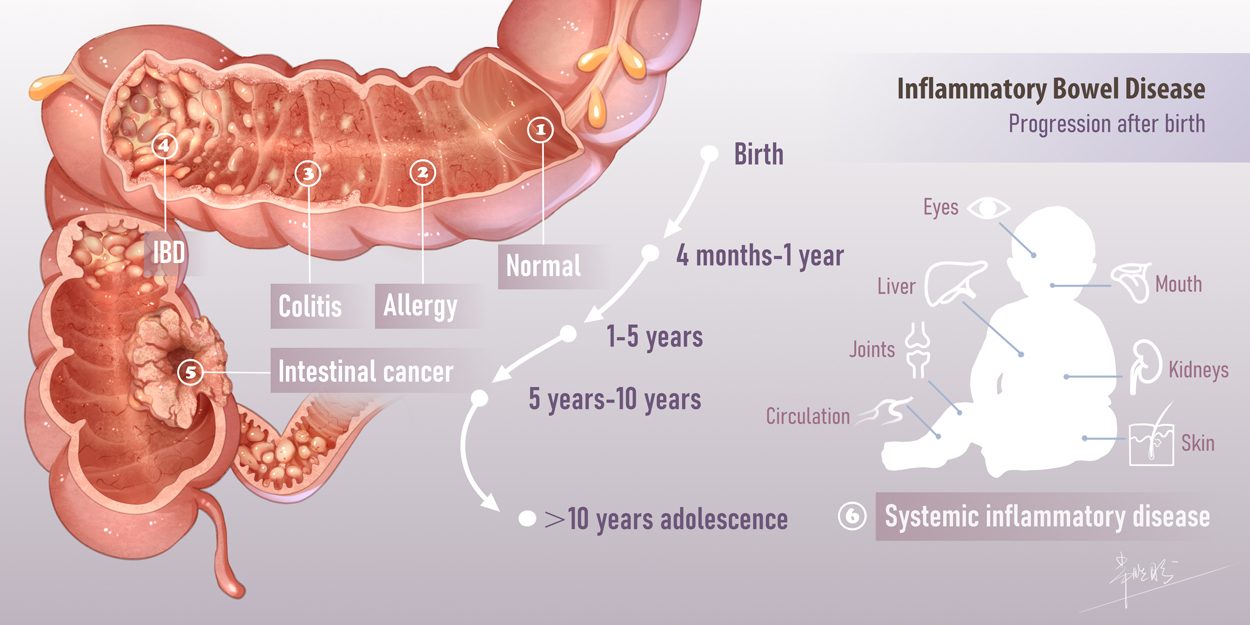 Food Allergy, Colitis and Inflammatory Bowel Disease